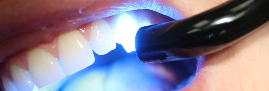 La révolution de l’implant dentaire à l’étranger : la révolution en marche ?